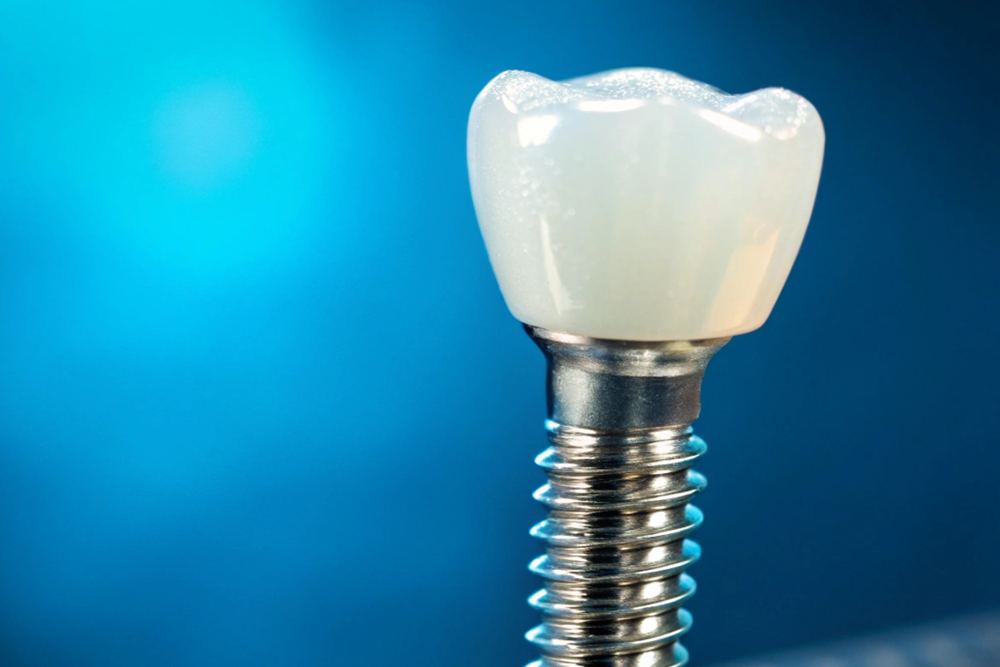 Dental implants recovery timeline chart at Fusion Implant Dentistry